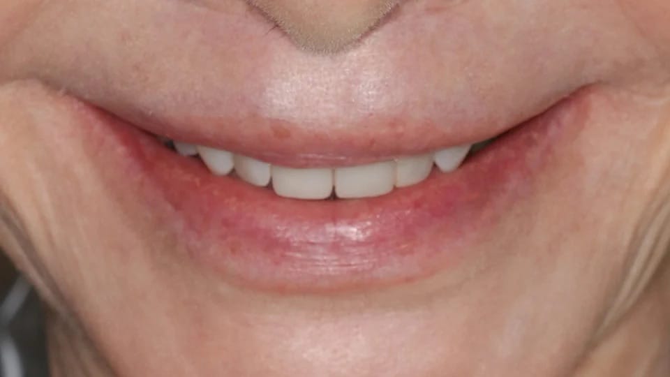 Anastasia Smile 09 before image