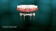Bar Retained Overdenture 003