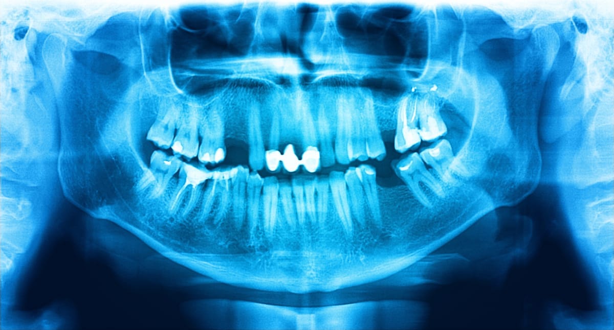 Do I Really Need Dental X-Rays? Do I Really Need Dental X-Rays?