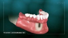 Locator Retained Overdenture (Reline) 002