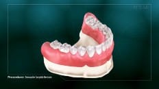 Removable Complete Dentures 004