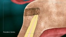 Apicoectomy image 004