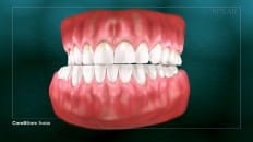 Bruxism (Clenching And Grinding) 001