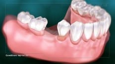 Single Tooth Loss 002