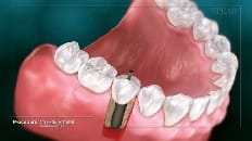 Screw-Retained Implant 004