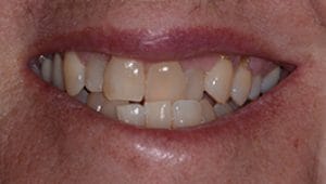 Crowns Before