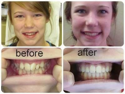 Before and after