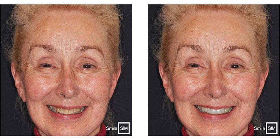 Before and after of a woman smiling