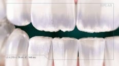 Understanding Tooth Wear 005
