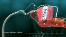 Sleep Appliances - Sleep Apnea 003
