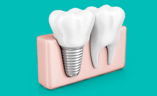 Which Tooth Replacement Method is Best for Restoring Missing Teeth? Which Tooth Replacement Method is Best for Restoring Missing Teeth?