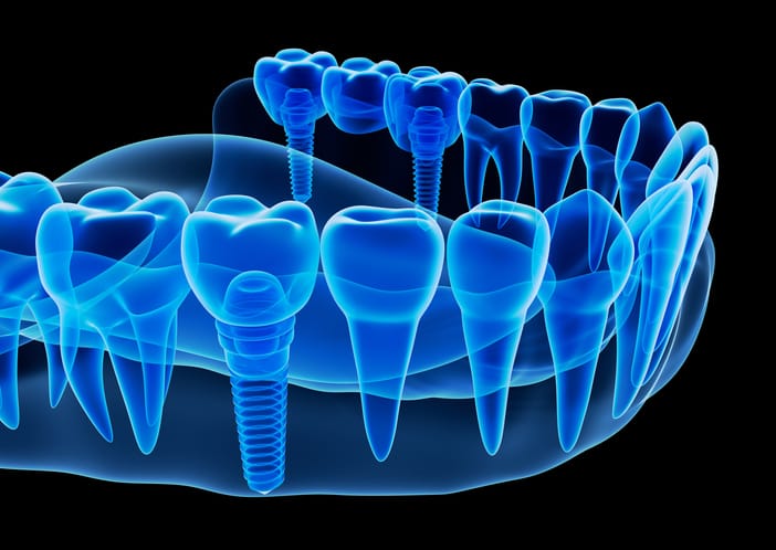 Important Recovery Notes Following Implant Placement Surgery Important Recovery Notes Following Implant Placement Surgery