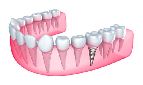 Avoiding Dental Implant Complications With Expert And Precise Planning Avoiding Dental Implant Complications With Expert And Precise Planning