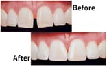 Three things you should know about dental veneers