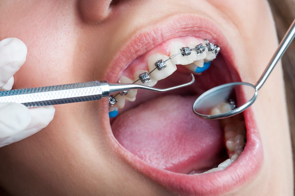 At Home Teeth Straightening – Not the Safest Option