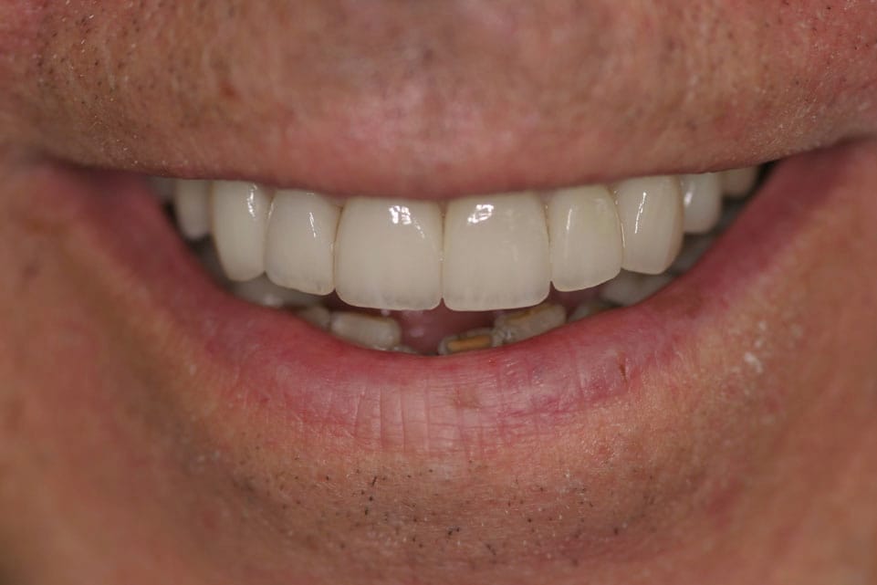 Rasner Smile gallery after 21