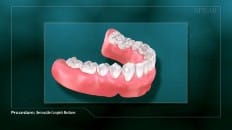 Removable Complete Dentures 002