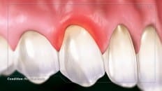 Peri-Implant Mucositis 003