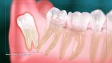 Impacted Third Molar 005
