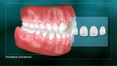 Veneers (Impression) 001