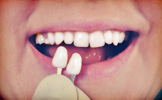 Steps for Getting Dental Veneers