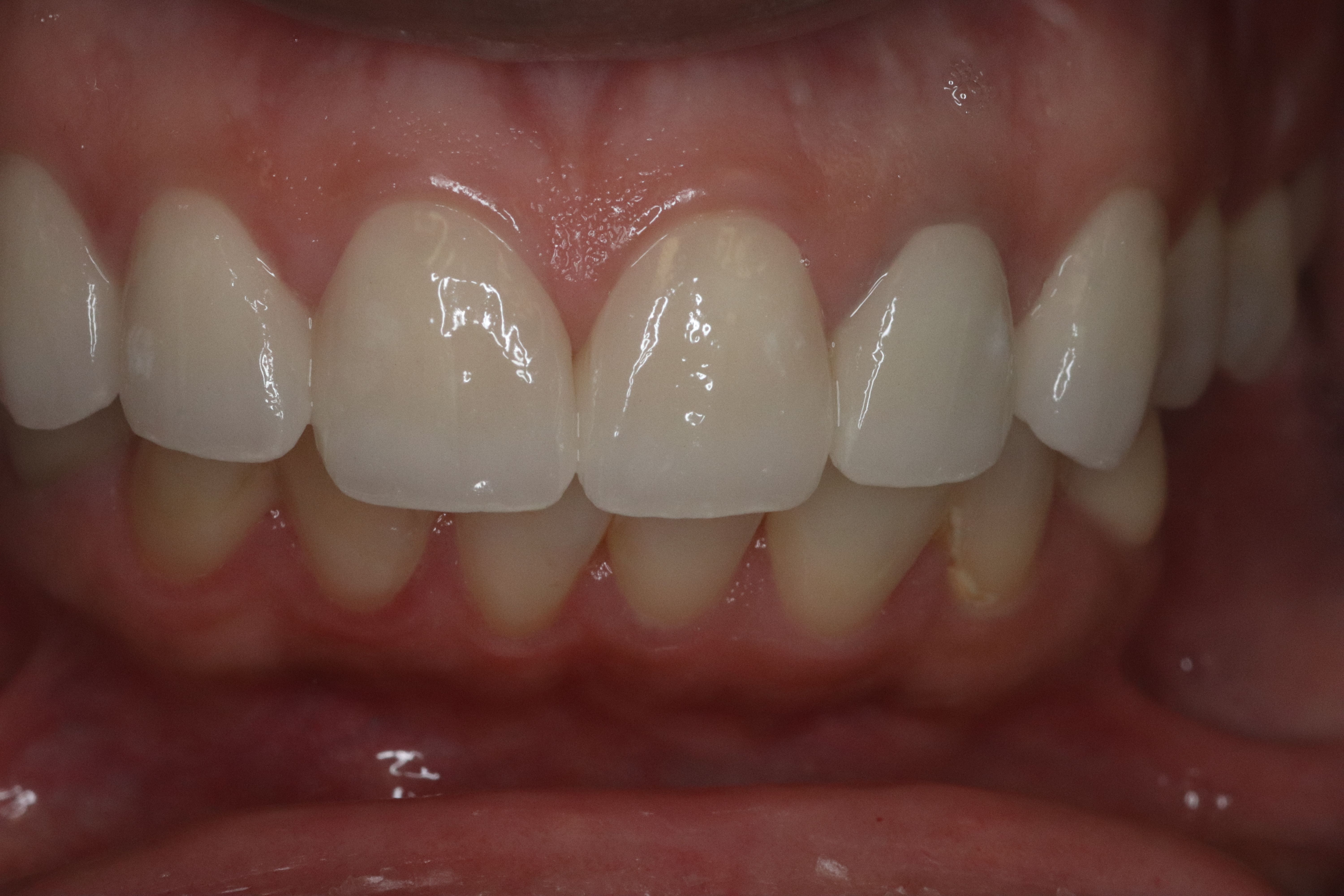 Rasner Smile gallery after 3