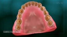 Understanding Tooth Wear 003