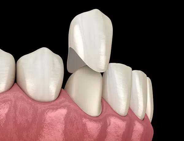 Front dental crown placement showing precise fit and restoration care