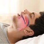 sleep apnea