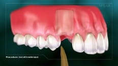 Bone Graft With Immediate Implant Placement 001