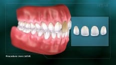 Veneers image 001