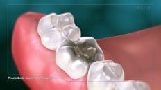 Composite Versus Amalgam Filling 004