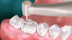Composite Filling (Posterior) 002