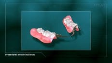 Removable Partial Dentures 002