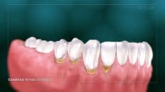 Non-Carious Cervical Lesions 001