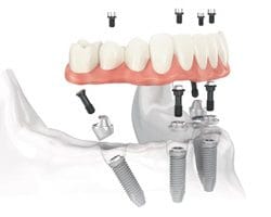 How To Complete Your Smile In 3 Hours Or Less!