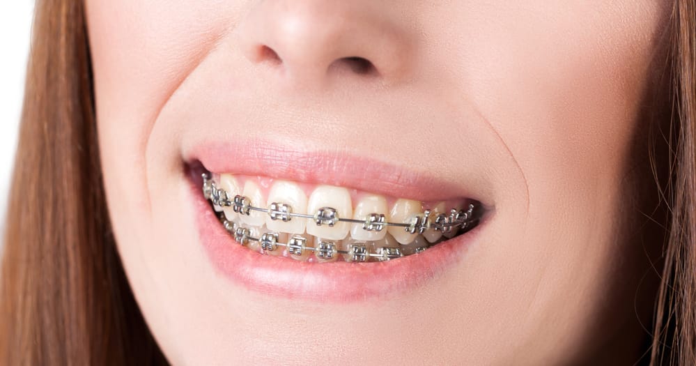 Could I Need Braces?