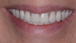 Dental Implants After