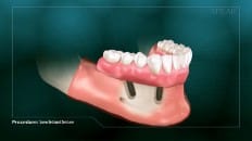 Screw Retained Dentures 002