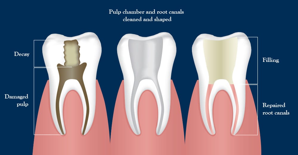 Virginia DC root canal image