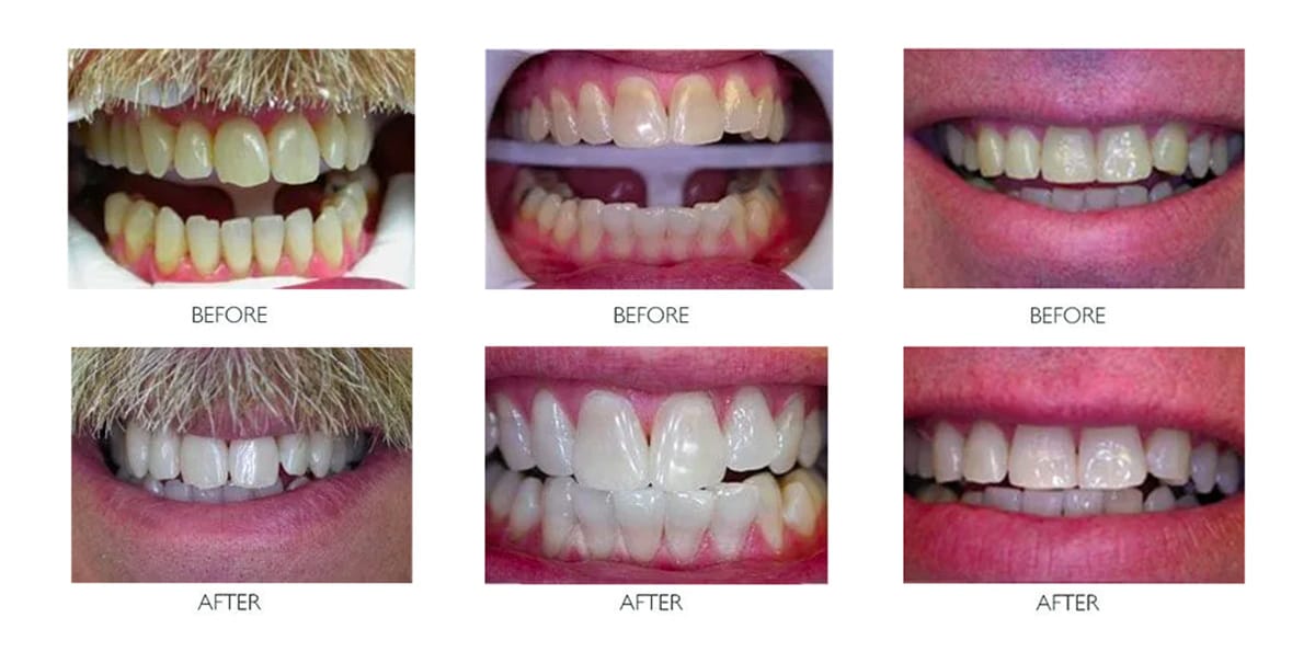 Teeth Whitening Before & After