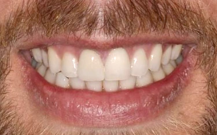2 (2). Patient JP (1 tooth)_ Single front tooth porcelain crown After