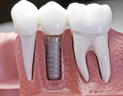 Single Implant Crown Illustration