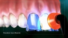 Composite Filling (Anterior) 003