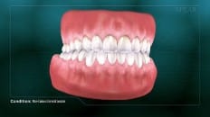 Non-Carious Cervical Lesions 007