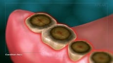 Bruxism (Clenching And Grinding) 003