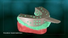 Removable Complete Dentures 003