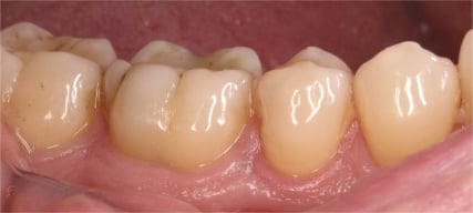 ChiefLaserCrown-PreOp-Side1
