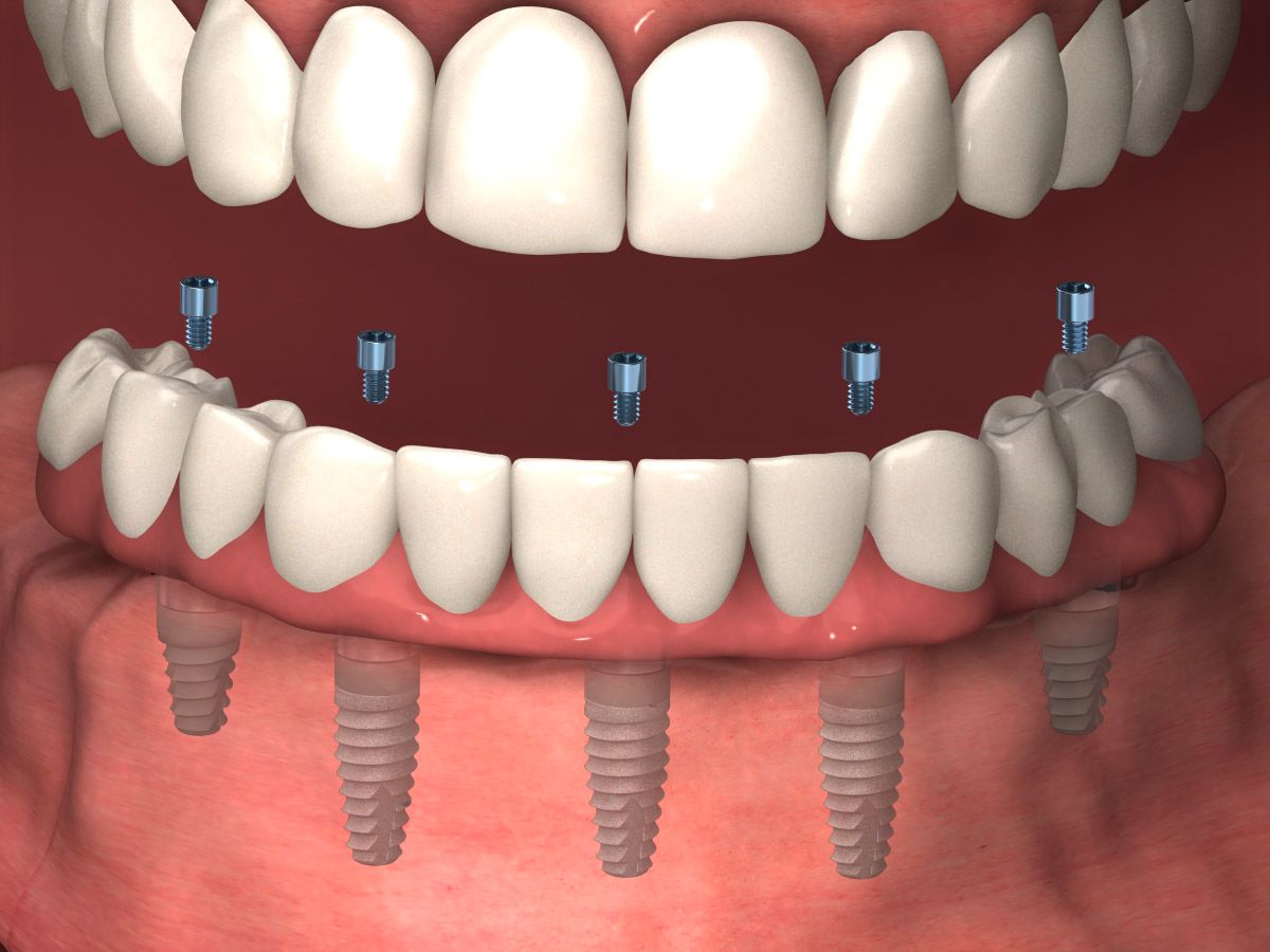 teethxpress