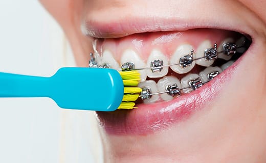 Dental Care Tips for Braces